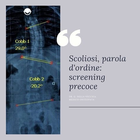 Scoliosi, alla terapia Manuale ma screening precoce